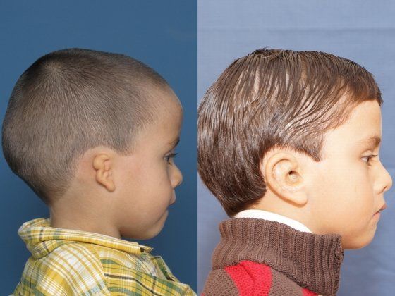 before and after inner ear and microtia surgery