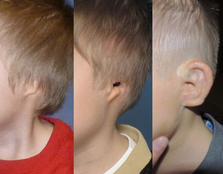 Various stages of surgical aural atresia repair